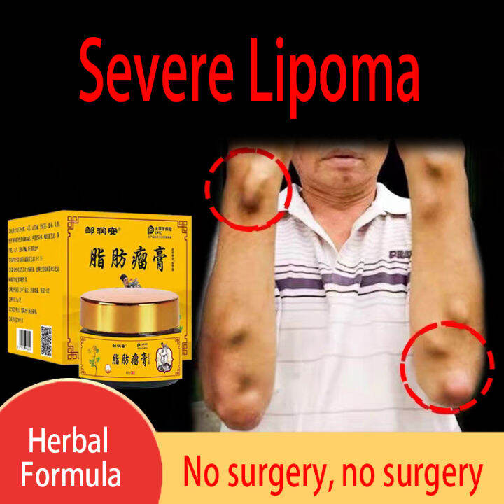 Lipoma Removal Cream Removes Subcutaneous Lipoma Lumps Treat Skin