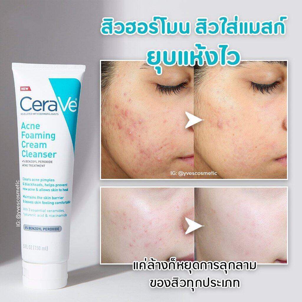 Cerave Acne Foaming Cream Cleanser 4％ Benzoyl Peroxide Acne Treatment 150ml Th