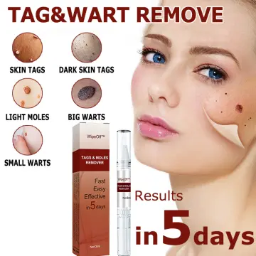 Mole Remover For Face Body, Tags Moles Remover Pen Fast Easy Effective In 5  Days Easy To Remove Tags, Moles, Warts