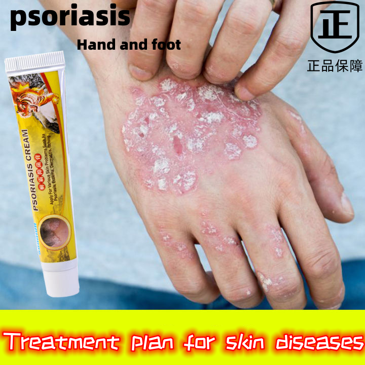 Psoriasis cream Sumifun skin cream and foot biting cream treat various