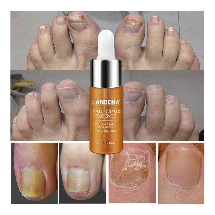 lanbena-nail-repair-essence-serum-fungal-nail-treatment-remove-onychomycosis-toe-hand-foot-skin-care