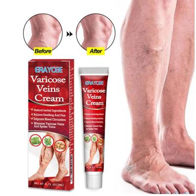 1ชิ้นครีม20กรัมสำหรับเส้นเลือดขอดที่เท้า S ครีม Relief เส้นเลือดขอดที่เท้าที่มีประสิทธิภาพเพื่อบรรเทาการรักษาอาการปวดแมงมุม Vasculitis Phlebitis