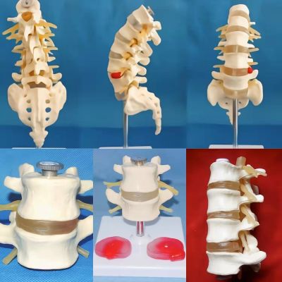 Section two to four five detachable lumbar lesions vertebral spine between the waist dish outstanding nerve body bone toy model