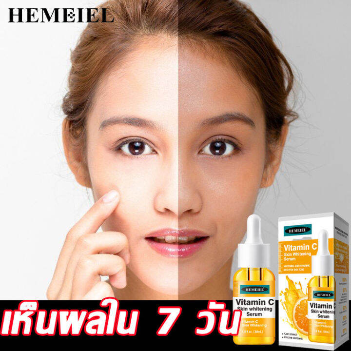 hemeiel-แผ่นลอกสิวเสี้ยน-กำจัดสิวเสี้ยน-ขัดสิวเสี้ยน-นุ่มและขจัดสิวหัวดำ