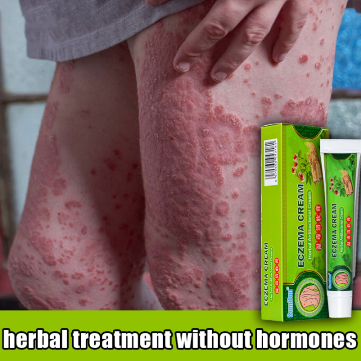 Eczema Psoriasis Skin Itching Pure Herbal Eczema Psoriasis Antifungal Treatment Cream Antifungal