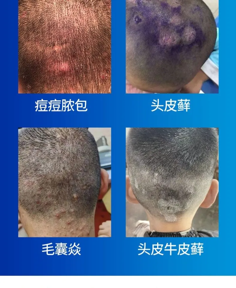 Tinea capitis (scalp ringworm) 