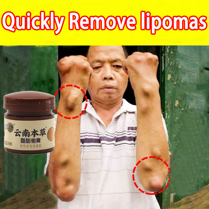 Effective Lipoma Removal Cream - Lipoma Removal Ointment Treat Tumor 