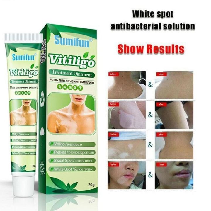uclanka-20g-chinese-vitiligo-pigment-melanin-promotes-the-of-skin-whitening-leukoplakia