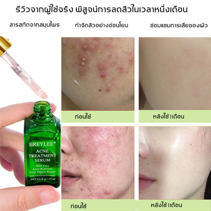 breylee-เซรั่มลดสิว17ml-เซรั่มรักษาสิว-สามารถลดสิว-บล็อกสิว-สิวไม่อักเสบ-สิวหัวขาว-สิวหัวดำ-กำจัดสิว-สิวอุดตัน-สิวผด-ไม่มีหัว-หลุมสิว-ซ่อน-ลดรอยแผลเป็นจากสิว-รอยดำจากสิว-ครีมแต้มสิว-เจลรักษาสิว-ครีมกำ