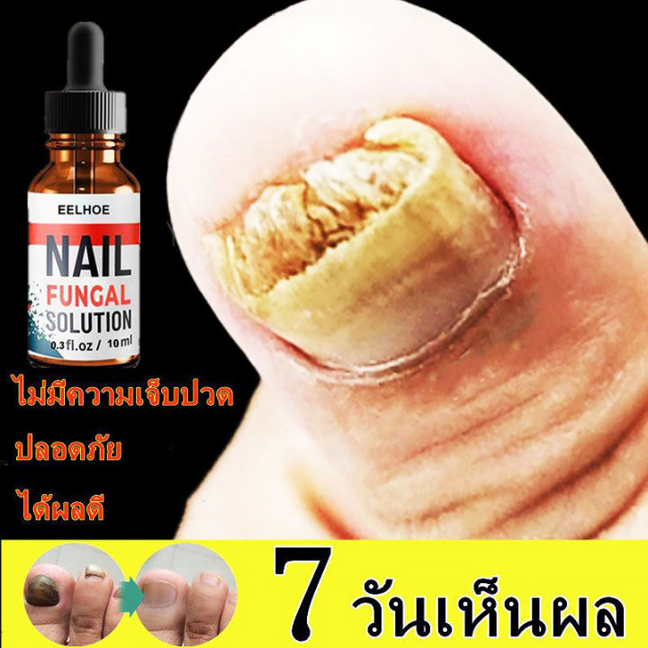 eelhoe-น้ำยาบำรุงเล็บ30ml-ยารักษาเล็บขบ-เล็บที่มีเชื้อรา-ต่อต้านแบคทีเรีย-รักษาเล็บเสีย-ทำให้เล็บเกิดใหม่-เล็บสวยขึ้น-ยารักษาเล็บ-ยาบำรุง