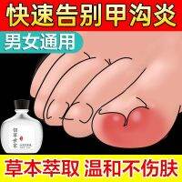 Hundred grass family paronychia dedicated ingrown nail redness and swelling pain suppuration antibacterial liquid toenails into meat for correction