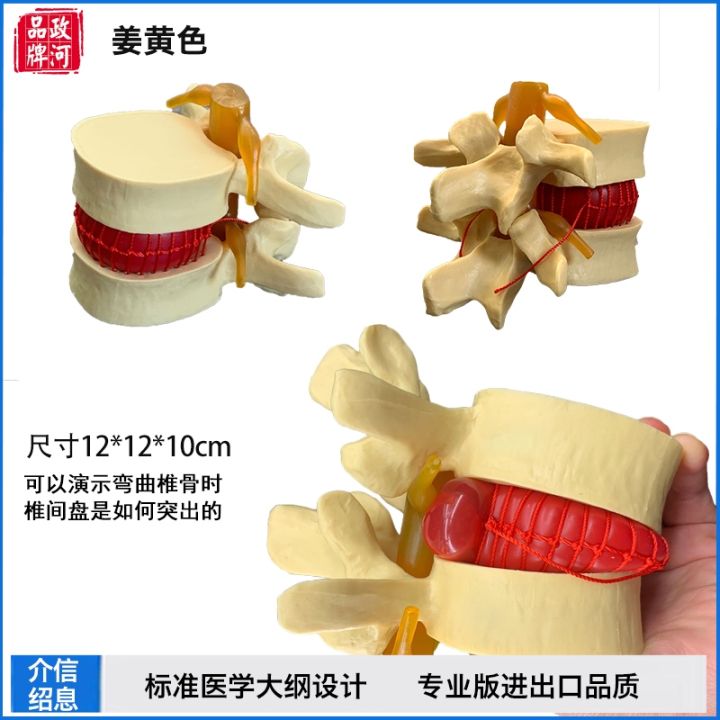 zheng-river-extrusion-model-of-lumbar-prominent-vertebral-spine-human-body-bone-bonesetting-massage-medical-demonstration-teaching
