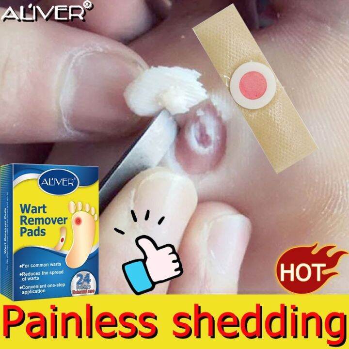New 2023 ALIVER wart remover pads 24 posts Effectively remove（Warts