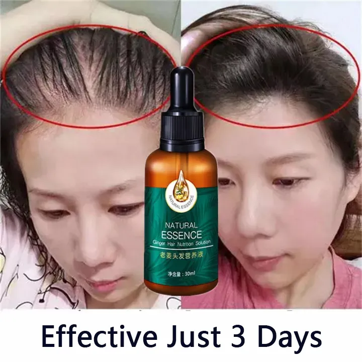 100% Natural Ginger Hair Serum Hair Grower Fast Long Hair Hair Treatment Minoxidil Hair Grower Castor Oil For Hair Growth Spray Essence Preventing Baldness Consolidate Hair Loss Treatment For Men And Women | 100% Natural Ginger Hair Serum Hair Grower Fast Long Hair Hair Treatment Minoxidil Hair Grower Castor Oil For Hair Growth Spray Essence Preventing Baldness Consolidate Hair Loss Treatment For Men And Women |