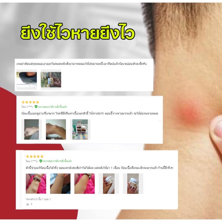 lipoma-removal-cream-ครีมก้อนเนื้องอกไขมัน-สมุนไพรกำจัด-ก้อนเนื้อใต้ผิวหนัง-ก้อนซีสต์-30g-ก้อนไขมันแข็ง-เนื้องอกไขมัน