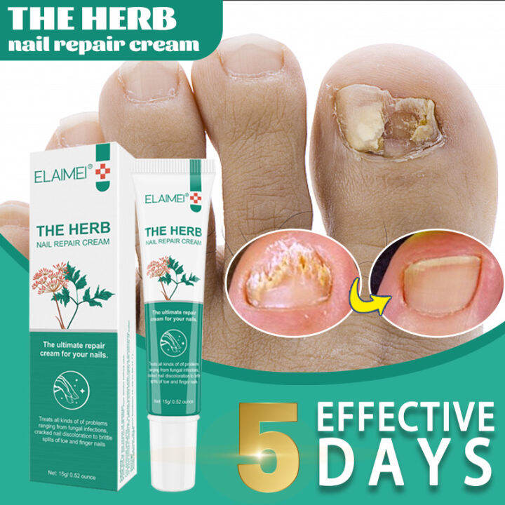 nail fungus treatment nail repair treatment nail solution emtrix fungal