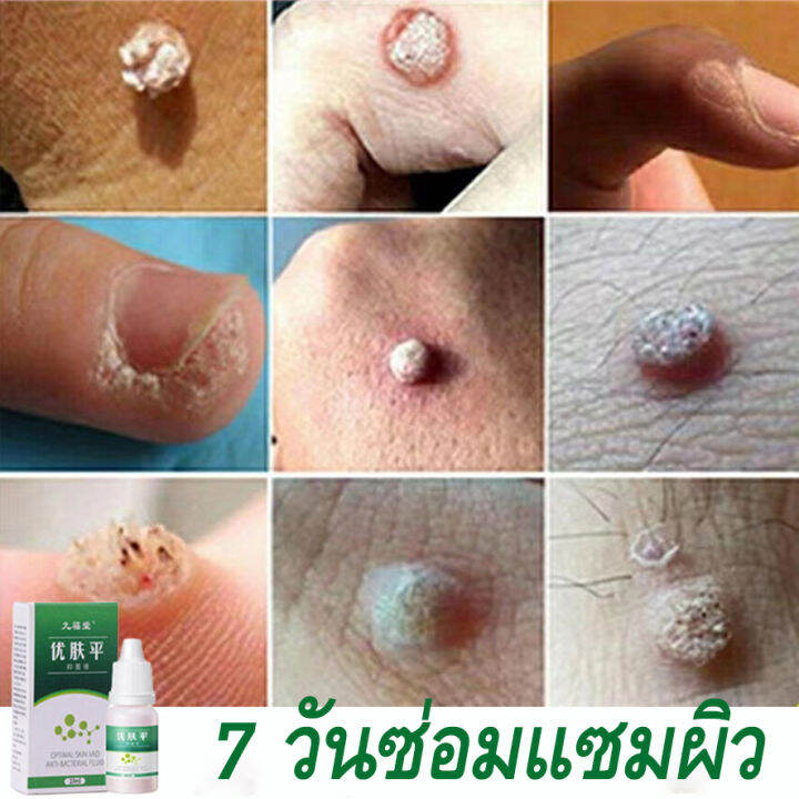 wart-removal-liquid-เอสเซ้นลอกหูด-10ml-ยาแต้มหูด-ลอกหูดตาปลา-ปลอดภัยไม่เจ็บตัว-ขจัดติ่งเนื้อ-เอสเซ้นลอกหูด-ไม่ทิ้งร่องรอยป-ครีมกําจัดไฝหูดติ่งเนื้อ