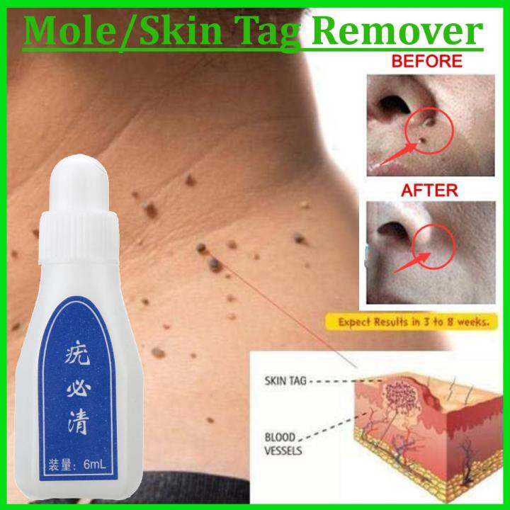 Voto Wart Remover Skin Tag Mole And Genital Wart Remover 12 Hours Kill Skin Care Lazada Ph