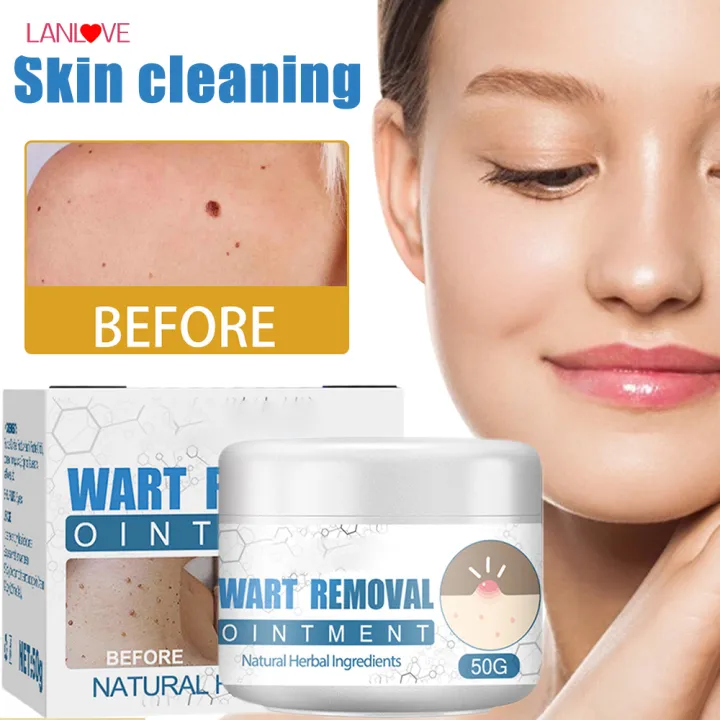 LANLOVE Flat Wart Facial Cleansing Cream Wart Removal Natural Herbal ...