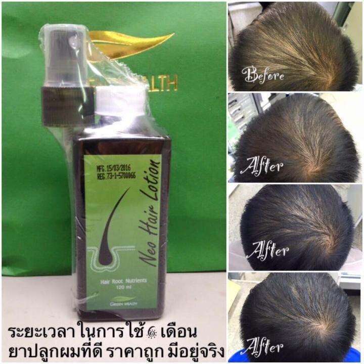 neo-hair-lotion-นีโอแฮร์-ผลิตภัณฑ์สเปรย์ปลูกผมและบำรุงรากผม-120-ml-1ขวด