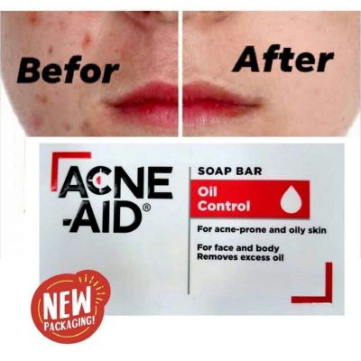 Acne-Aid bar soap 100g. สบู่ก้อน Acne-Aid เหมาะสำหรับผิวแพ้ง่าย เป็นสิวง่าย EXP 04/2025.