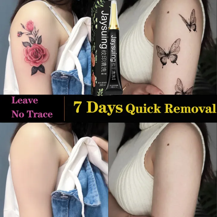 Laser Tattoo Removal vs Tattoo Removal Creams  Whats the verdict