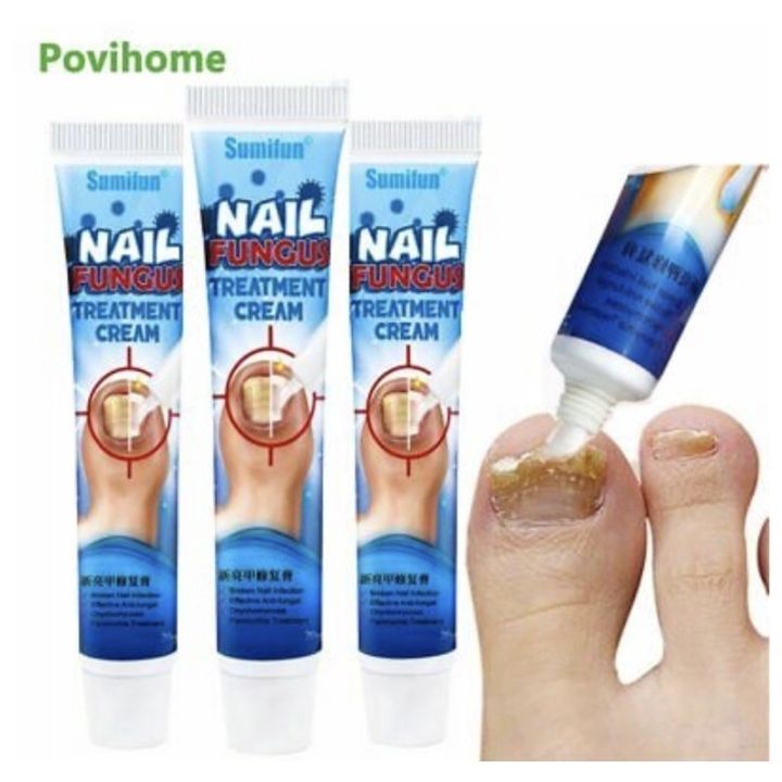Ubat kuku kaki dan tangan kulat Nail fungus treatment cream Sumifun