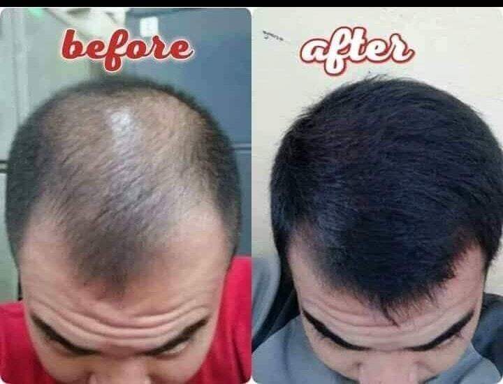 HAIR GROWER / 150 ML / PAMPAKAPAL NG BUHOK / PAMPATUBO NG BUHOK / PARA ...