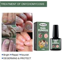 Nail Fungal Cure Nail Fungus Removal Liquid Nutritious Anti Paronychia Onychomycosis Foot Repair Fungal Nail Repair TSLM1