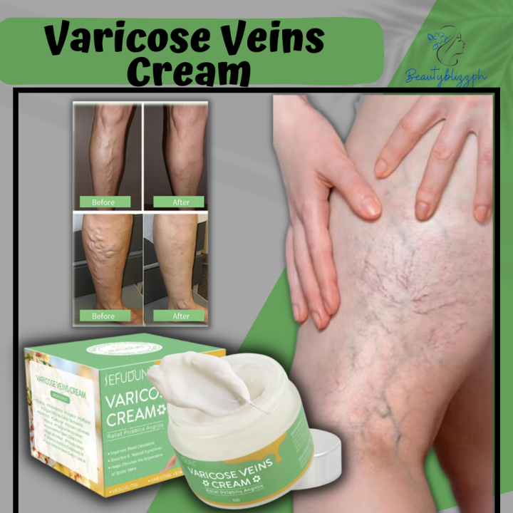 Sefudun Varicose Veins Cream Varicose Vein Treatment Cream Spider Vein Treatment For Legs