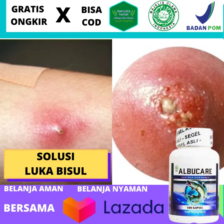 Obat Bekas Luka Bisul, Pengering Luka Bisul Basah Bernanah Di Anus Paha