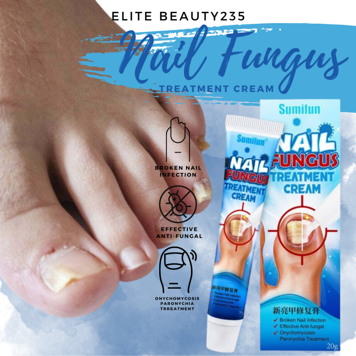 [AUTHENTIC] Nail Fungus Treatment Cream (Effective & Fast Result ...