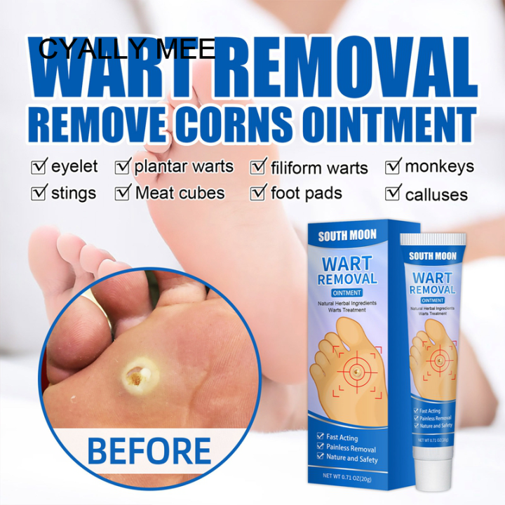 【Ready!】Wart Remover Removing Corns Cream Flat Plantar Warts Prickles