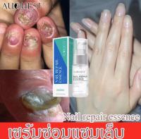 R.เห็นผลใน10วัน AuQuest เซรั่มทาเล็บ20ml  น้ำมันทาเล็บ เซรั่มทาเล็บเสีย ออยทาเล็บ เล็บเท้า เชื้อราเล็บมือ ทาเชื้อราที่เล็บ น้ำยาทาเล็บ เล็บเสีย น้ำยาล้างเล็บ เซรั่มทาเล็บ เล็บดีขึ้น เล็บไม่เรียบ เล็บแตก เล็บไม่แตกอีก เล็บเปราะ