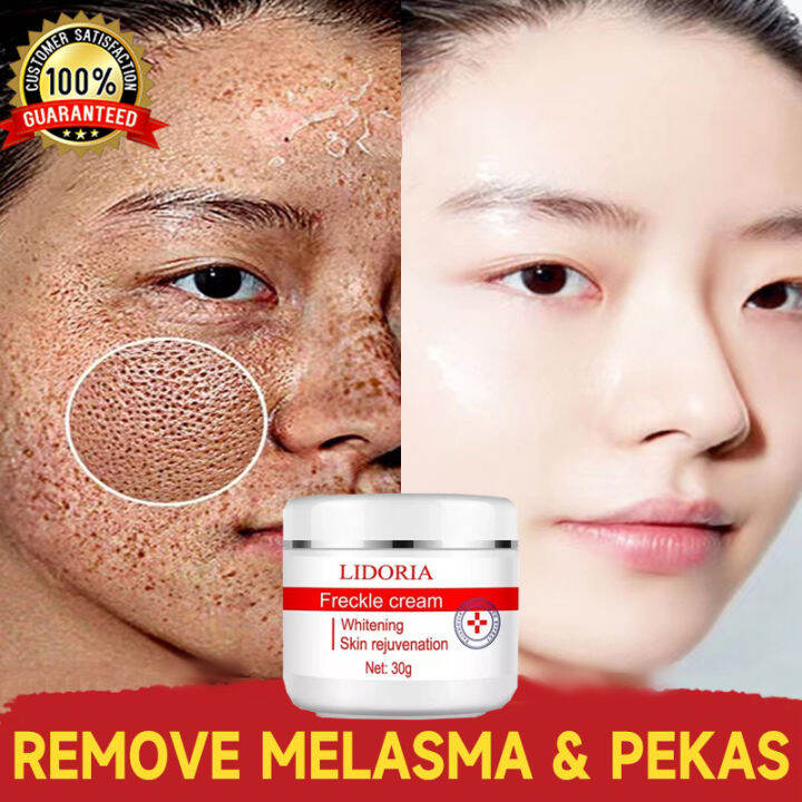 melasma and pekas remover cream original Spots & Blemishes from japan japanese to dark spots
