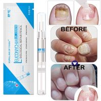 Favogue【Readyสต็อก】 [ส่งเร็ว] 3MLการรักษาเล็บเชื้อราปากกาOnychomycosis Paronychiaทรีทเมนท์เล็บป้องกันเชื้อราเล็บติดเชื้อจีน