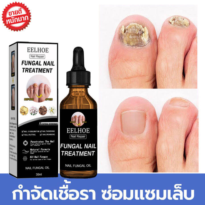 บำรุงเล็บ กันเชื้อราเล็บ รักษาเชื้อราเล็บ เซรั่มบำรุงเล็บ ออยบำรุงเล็บ Nail  Fungus Medicineยาแก้เชื้อราที่เล็บ ครีมบำรุงซ่อมแซมเล็บ ครีมบำรุงเล็บ ยาทา เชื้อราที่เล็บ บำรุงเล็บเสีย ยารักษาเล็บ เชรั่มรักษาเล็บ เล็บเชื้อรา ยารักษา เล็บ เซรั่มเล็บขบ ยาแก้ ...