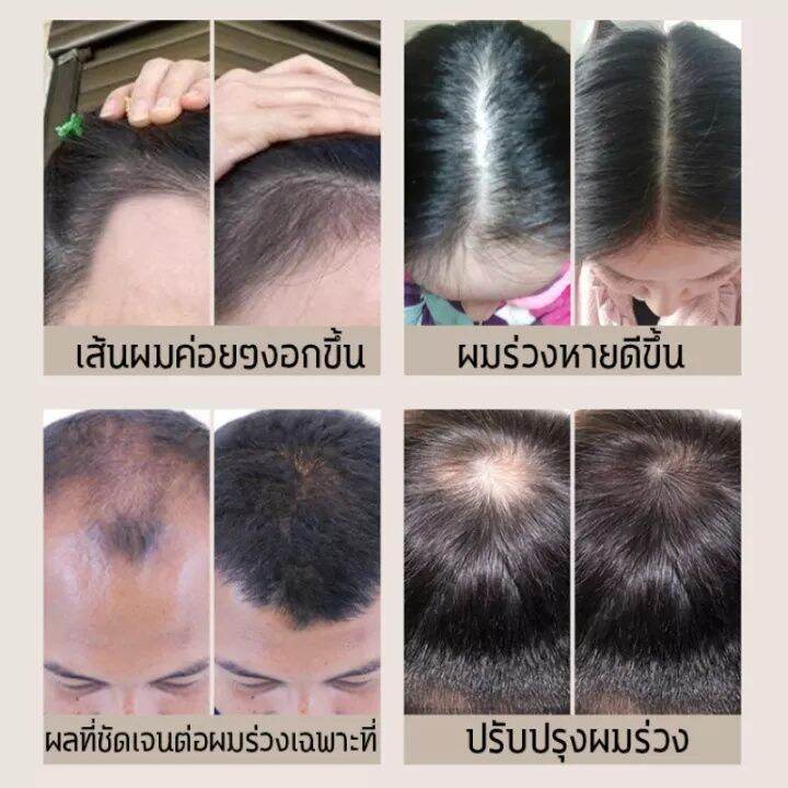 ของแท้-100-zenshow-แชมพูเร่งผมยาว-แชมพูแก้ผมร่วง-แชมพูขิงเพียว-แชมพูลดผมร่วง-ยาสระผมแก้ร่วง-แชมพูขิงของแท้-hair-loss-shampoo-ยาสระผมเร่งยาว-สูตรน้ำขิง-ปลูกผมอย่างอ่อนโยน-บำรุงรากผม-ปลูกผม-เร่งผมเกิดให