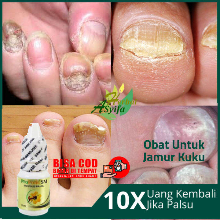 Obat Jamur Kuku, Obat Infeksi Jamur Kuku, Salep Jamur Kuku di Tangan
