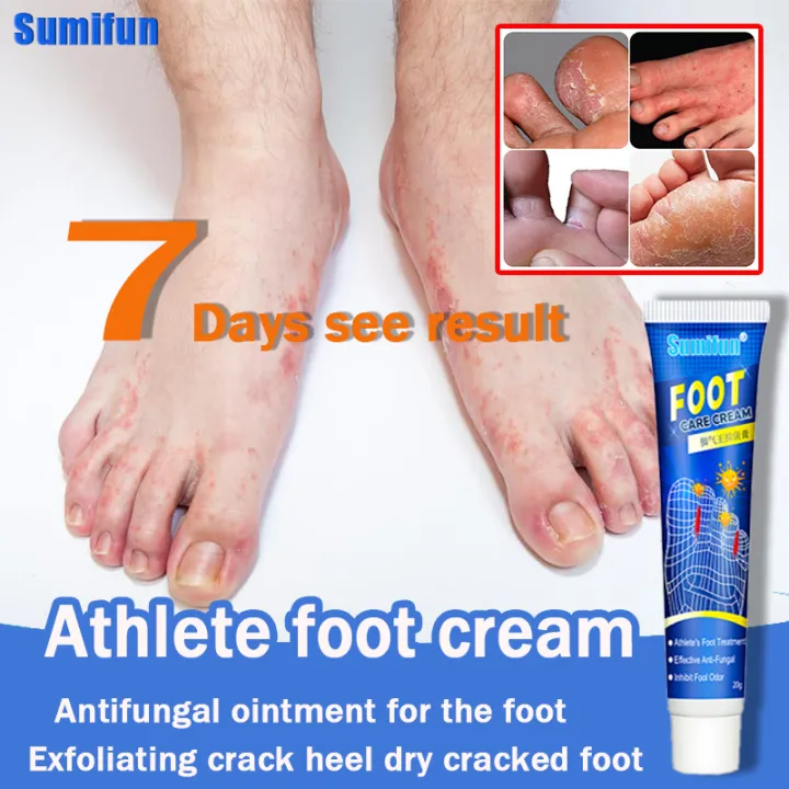 100 Safe Effective sumilfun Athlete foot cream ointment for itchy skin and allergy Effectively