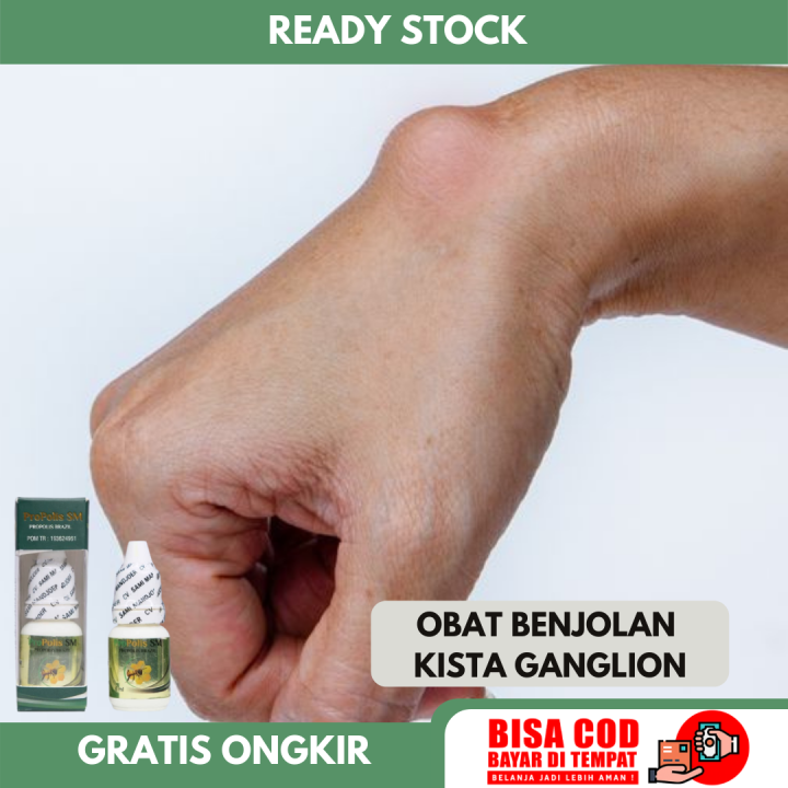 Obat Oles Penghancur Benjolan Ganglion - Obat Benjolan Ganglion - Obat ...