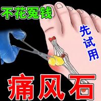 Gout-Specific Uric Acid High Pain Fengling Lowering Melting Crystal Big Toe Finger Joint Swelling Night