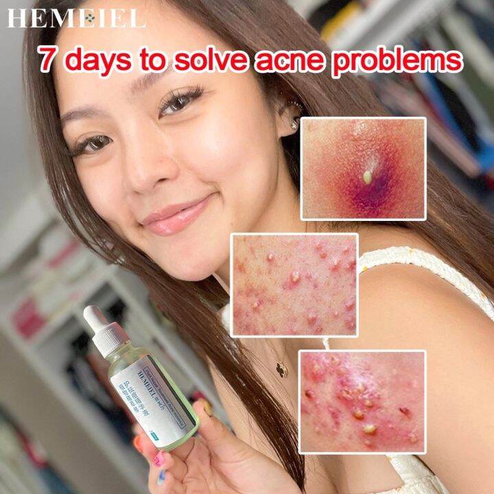 HEMEIEL Pimple Marks Acne Remover/Clindamycin For Acne/Back Acne Treatment/Pang Tanggal Ng
