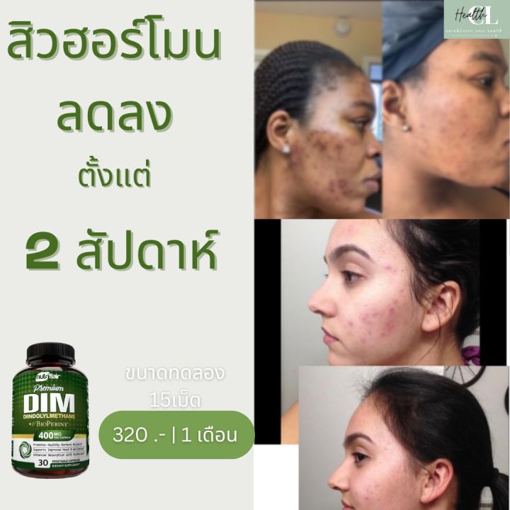 อาหารเสริมสำหรับผู้หญิง-dim-supplement-400mg-ปรับความสมดุลให้ฮอร์โมน-สร้างการเผาพลาญที่ดี-นำเข้าจากอเมริกา