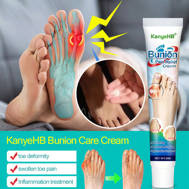 niaoxsd KanyeHB Bunion Pain Relief Cream | Lazada PH