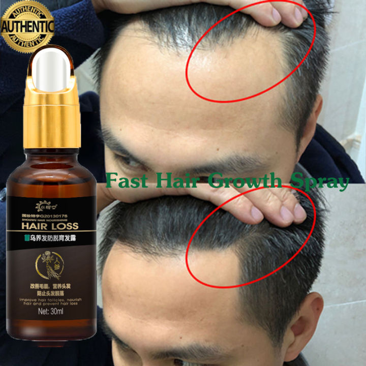 Hair Serum Hair Tonic For Hair Growth Serum Rambut 30ml Plant Extracts Fast Hair  Growth Serum Hair Treatment Essence Prevent Hair Loss Promote Hair Growth  Restore Thick Hair Repair Damaged Hair Care |