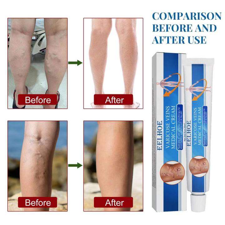 EELHOE VARICOSE VEINS MEDICAL CREAM APPLICABLE TO COLD COMPRESS Lazada PH