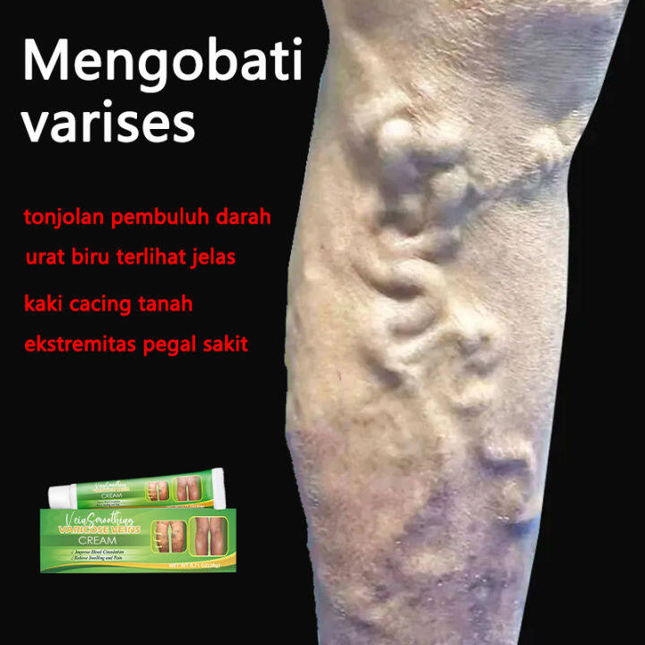 Pembuluh Darah Kaki Benjolan Urat Biru Krim Pijat Varises Kaki Cacing