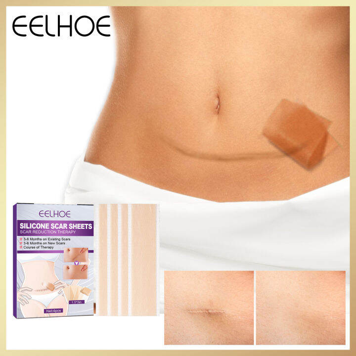 Eelhoe Silicone Scar Patch For Reducing Scars Scalding Scars Cesarean Section Scars Hypertrophic