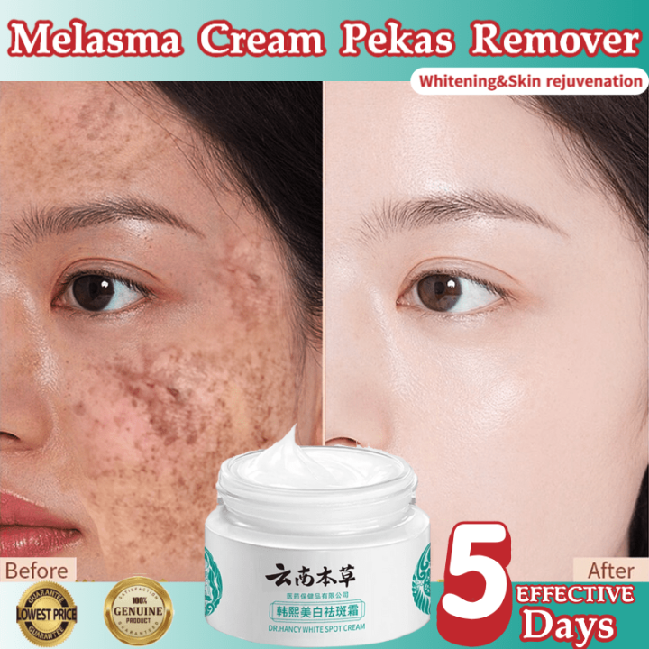 Japanese melasma remover cream original melasma cream pekas remover Whitening Freckle Cream for